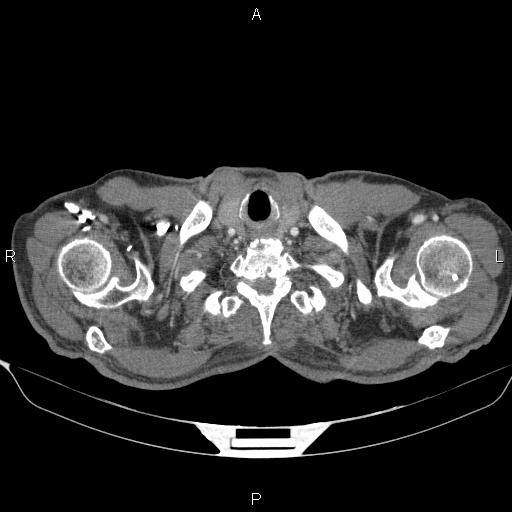 Dấu hiệu "CT mạch đồ" (CT Angiogram Sign)