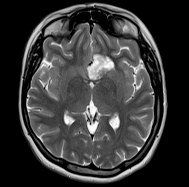Hình ảnh bọt xà phòng (DNET) - Soap bubble appearance (DNET)