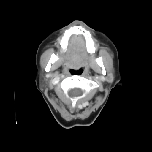 Ung thư biểu mô ống tuyến nước bọt (Salivary duct carcinomas - SDC)