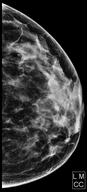 Vôi hóa da ở vú (Skin calcifications in the breast)