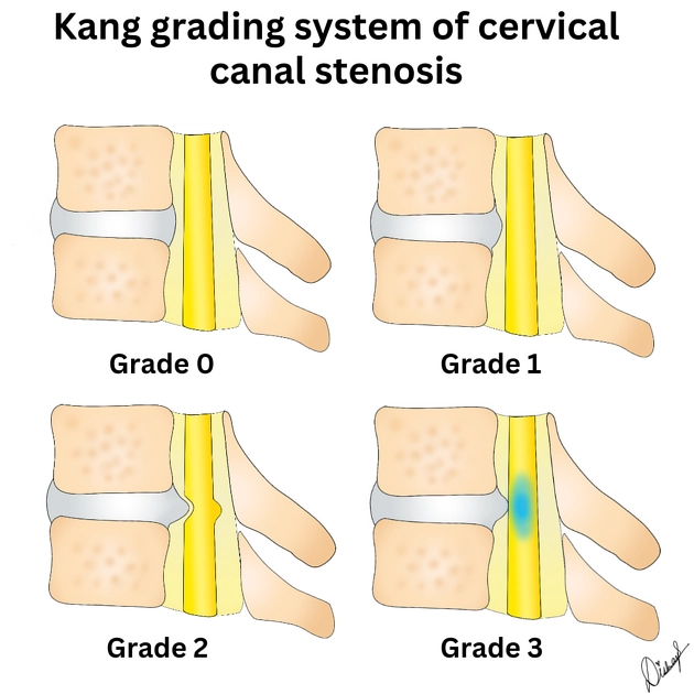 Hẹp ống sống cổ (Cervical canal stenosis)