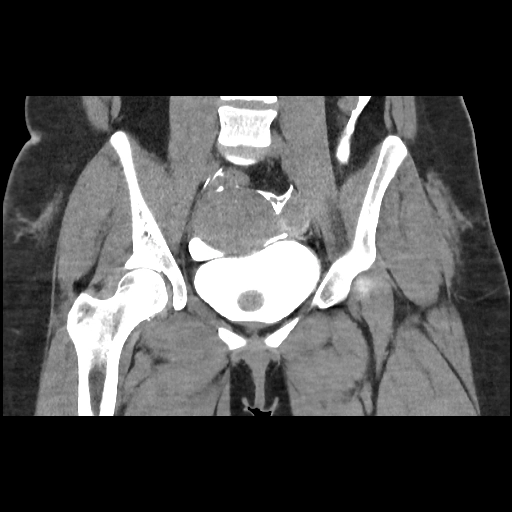 Chấn thương bàng quang (Urinary bladder trauma)