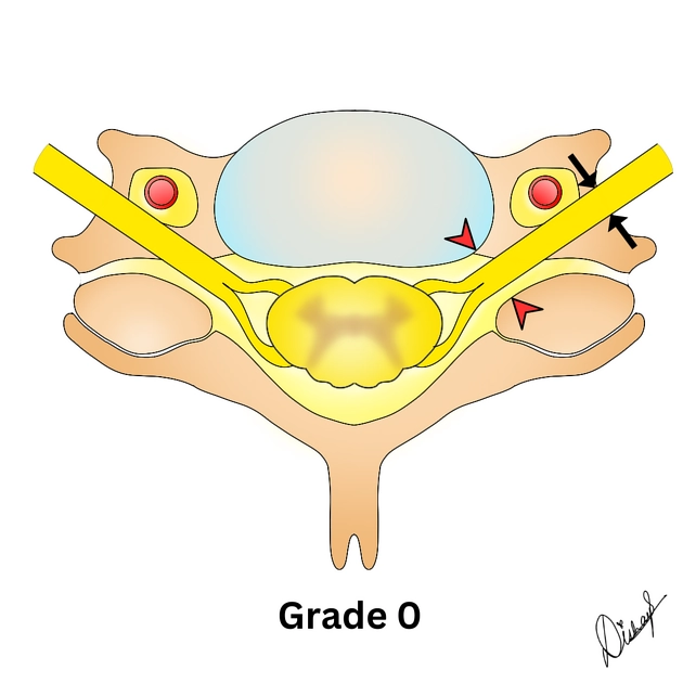 Hẹp lỗ liên hợp cổ (Cervical foraminal stenosis)