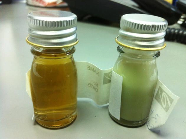 Thận ứ mủ (Pyonephrosis)