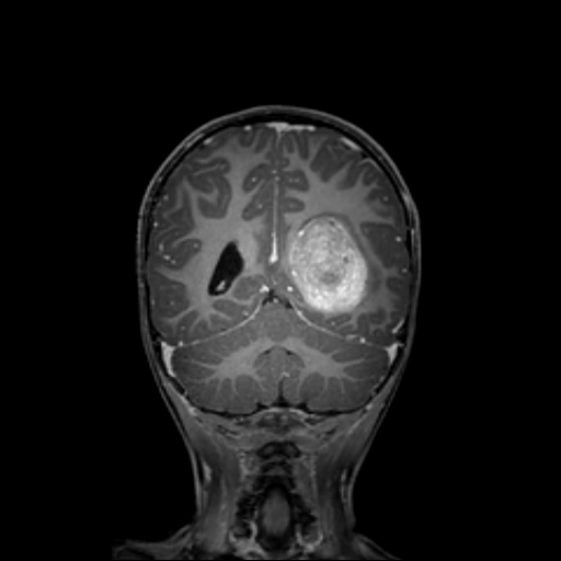 U nhú đám rối mạch mạc không điển hình (Atypical Choroid Plexus Papilloma- aCPP)