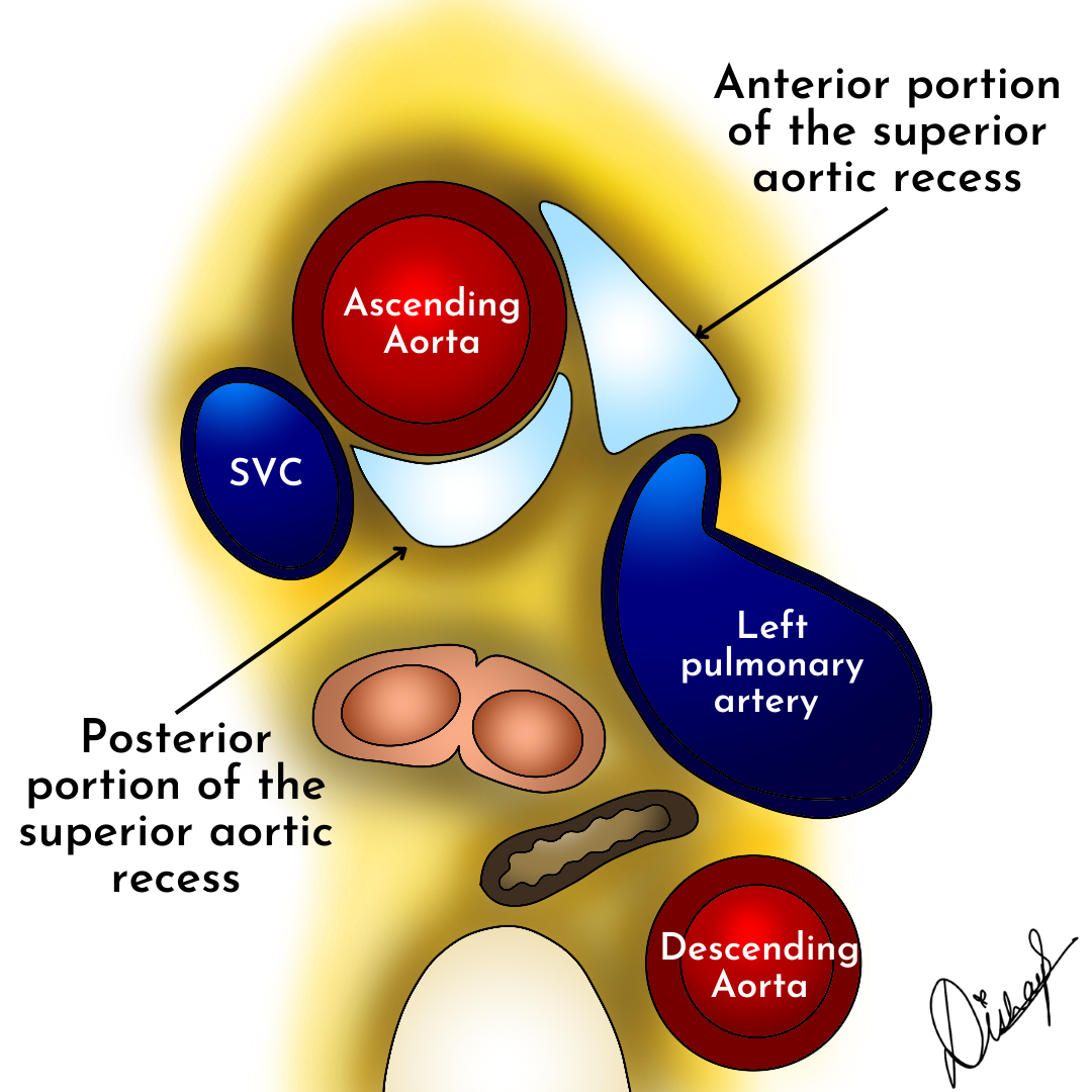 Các ngách màng ngoài tim (Pericardial Recesses)