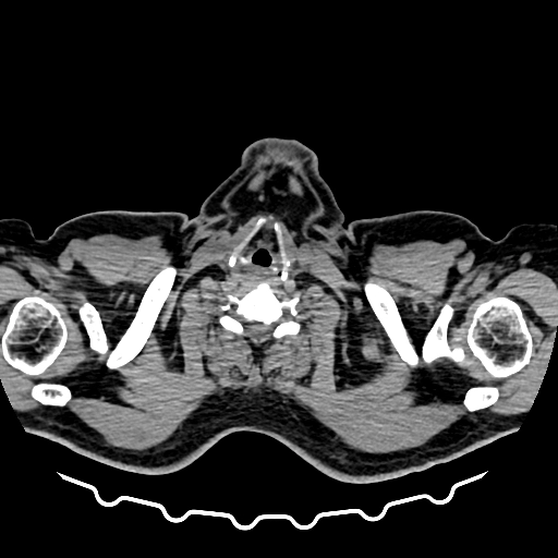 U thần kinh nội tiết trực tràng (Rectal Neuroendocrine Tumor - Rectal NET)