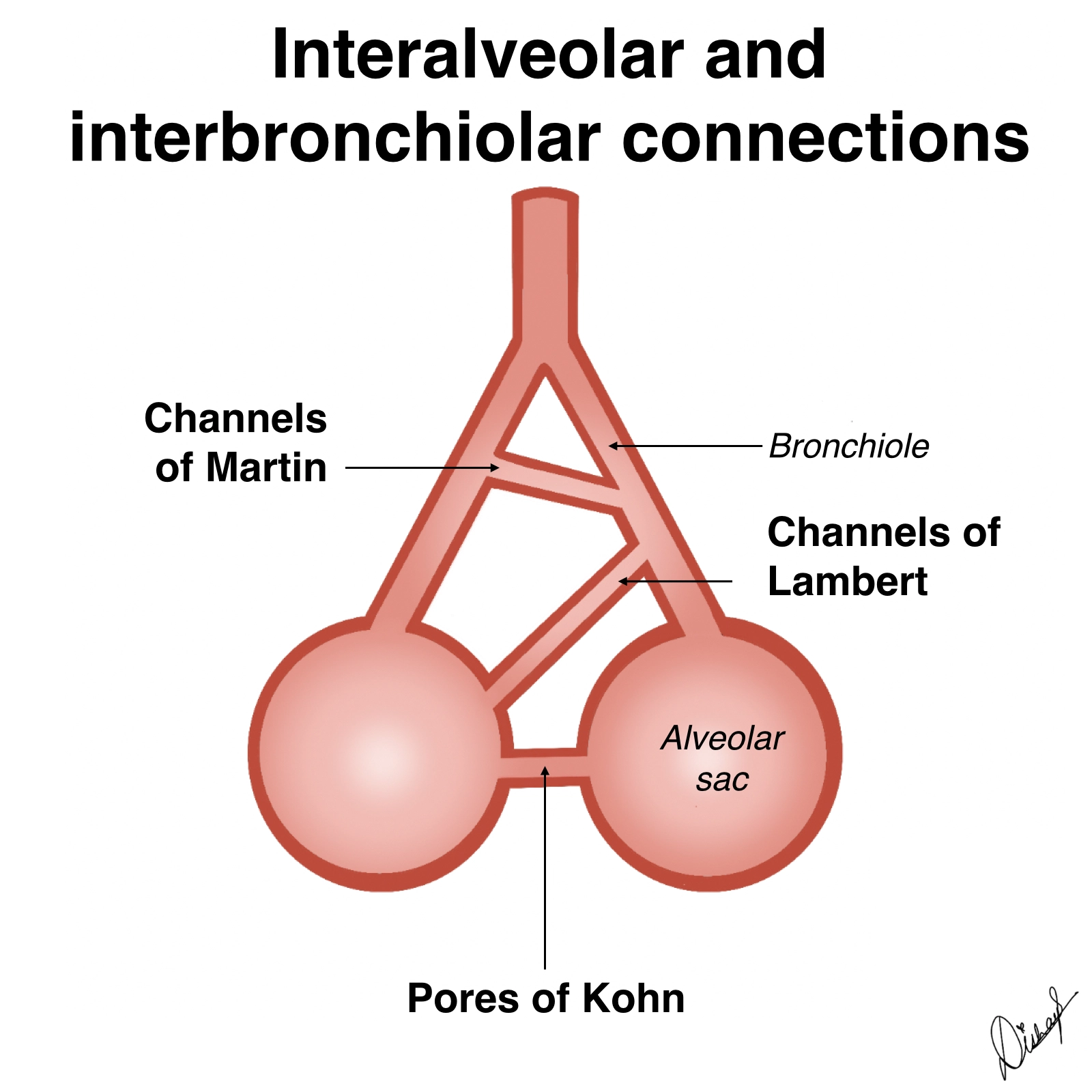 Viêm phổi tròn (Round Pneumonia)