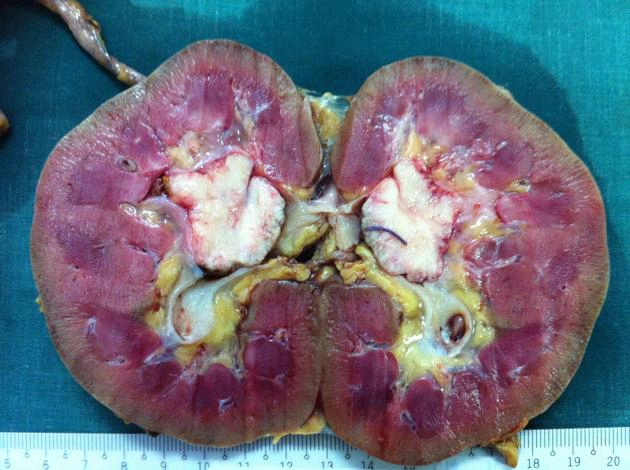 Ung thư biểu mô chuyển tiếp của bể thận (Transitional cell carcinoma of renal pelvis)