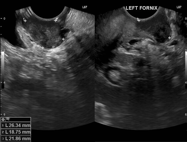 U xơ âm đạo (Vaginal leiomyoma)
