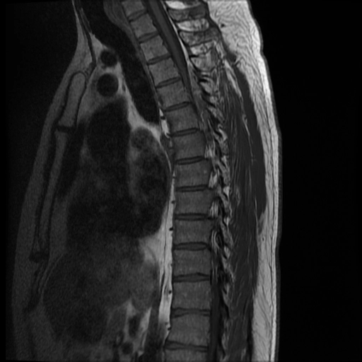 U mỡ mạch ngoài màng cứng (Epidural angiolipoma)