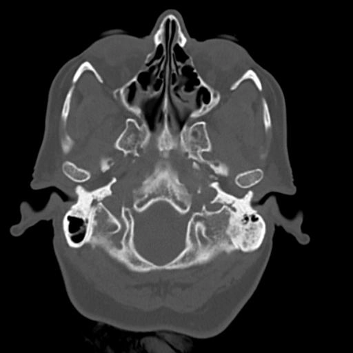 Thoát vị đỉnh xương đá (Petrous apex cephalocele)