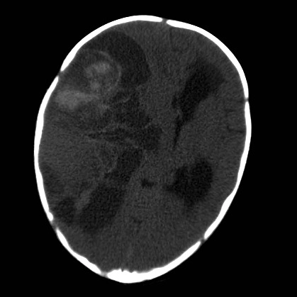 U phôi sắp xếp kiểu hoa hồng (Embryonal tumor with multilayered rosettes - ETMR)