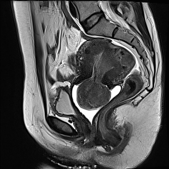 Thoái hóa Hyaline của u xơ tử cung (Hyaline degeneration of a leiomyoma)