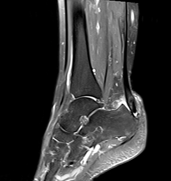 Hội chứng Haglund (gai xương gót)