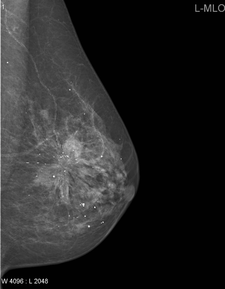 Tư thế chụp nhũ ảnh (Mammography views)