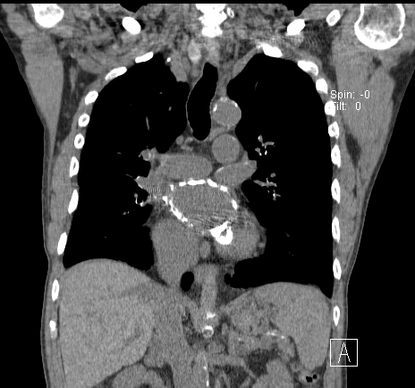 Vôi hóa nhĩ trái (Left Atrial Calcification)