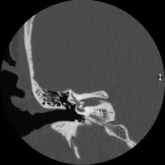 Hội chứng hở ống bán khuyên trên (Superior semicircular canal dehiscence syndrome - SSCDS)