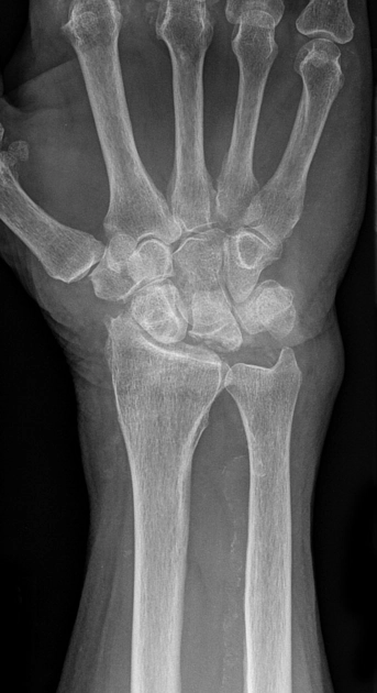 Mất vững về phía lòng tay từng đoạn (Volar Intercalated Segment Instability - VISI)