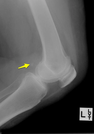Xương vừng cơ sinh đôi khớp gối (Fabella)