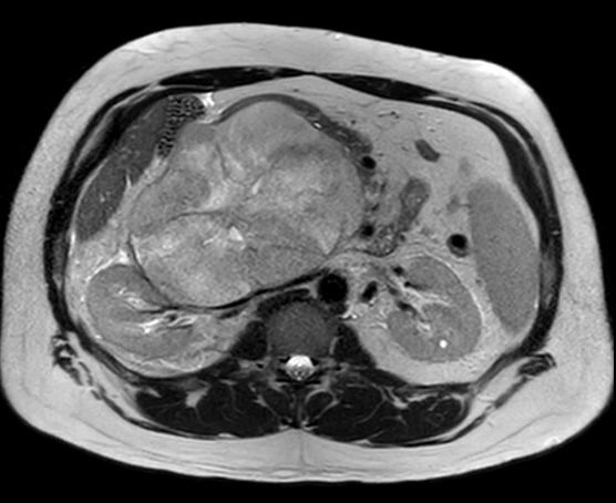 Sarcoma đa hình không biệt hóa sau phúc mạc (Undifferentiated Pleomorphic Sarcoma - UPS)