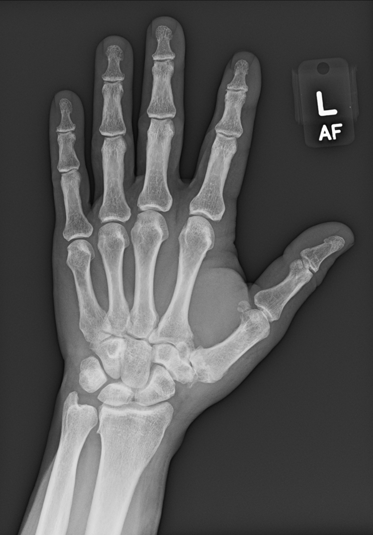 Gãy xương vừng ngón tay (Sesamoid bones)
