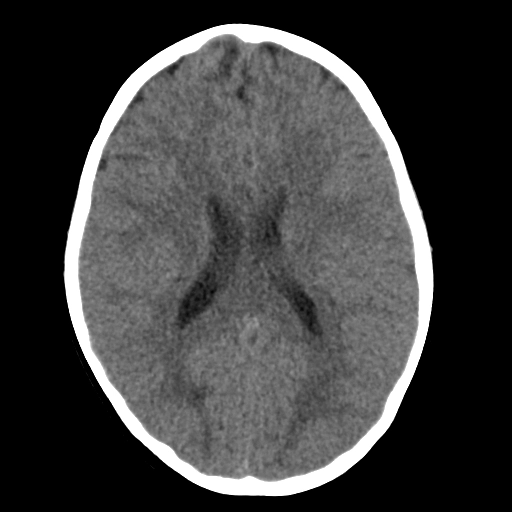 U thần kinh đệm hướng mạch (Angiocentric Glioma)