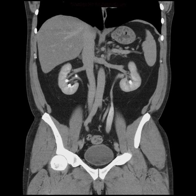 Niệu quản giãn bẩm sinh (Congenital megaureter)