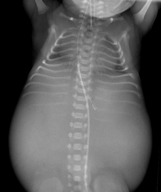Hở thân sống theo mặt phẳng vành (Coronal vertebral cleft)