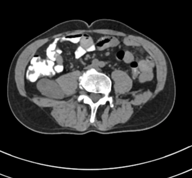 U bao dây thần kinh (Neurogenic neoplasms of the nerve sheath)