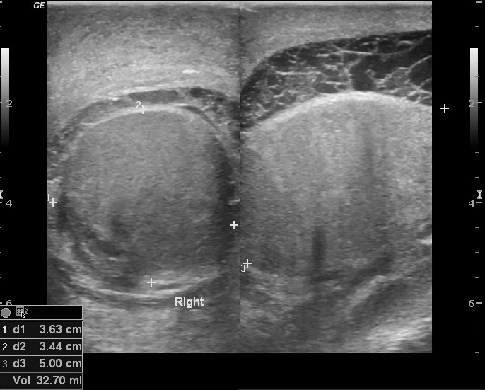 Tràn mủ tinh mạc (Scrotal pyocele)