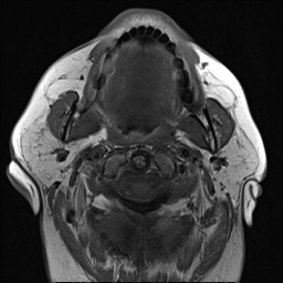 Lymphoma không Hodgkin ở tuyến mang tai (Parotid Non-Hodgkin Lymphoma)