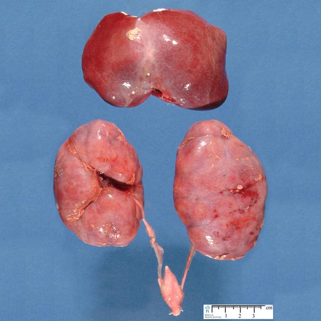 Bệnh thận đa nang di truyền lặn (Autosomal Recessive Polycystic Kidney Disease - ARPKD)