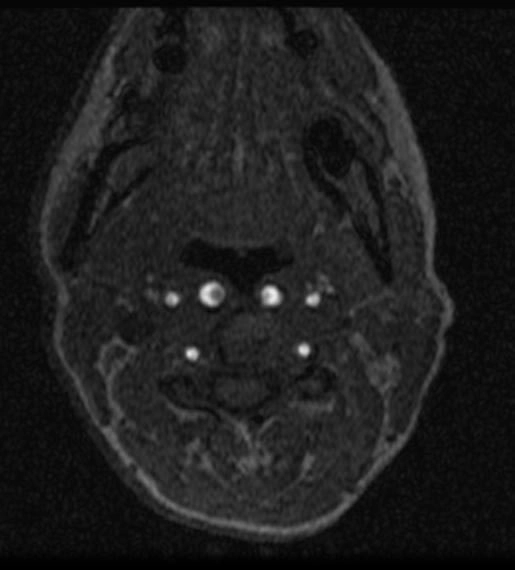 Động mạch cảnh hôn nhau (Kissing carotids)