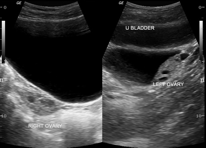 Nang vùi phúc mạc (Peritoneal inclusion cyst)