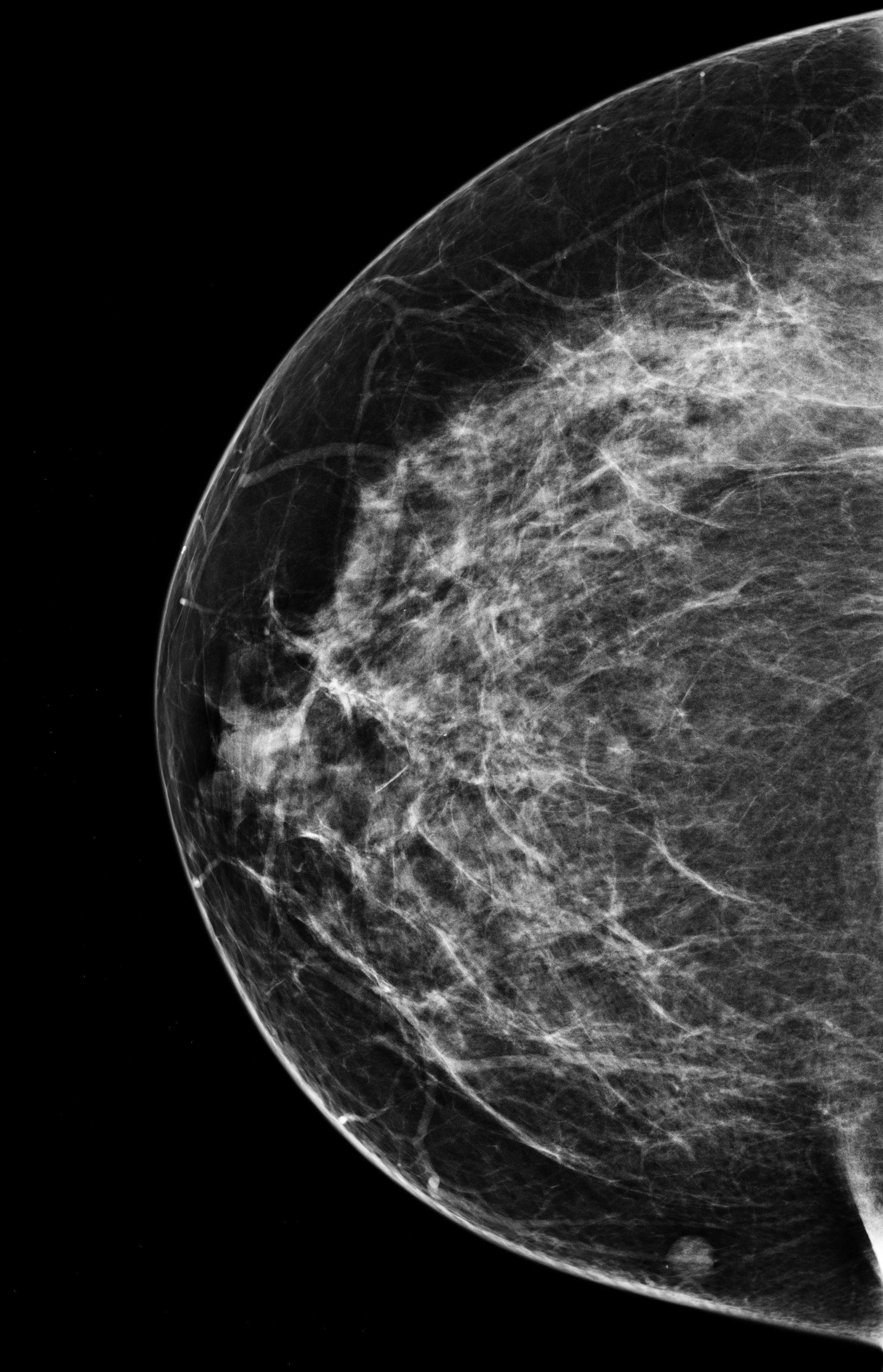 Nang bã nhờn tuyến vú (Breast sebaceous cyst)