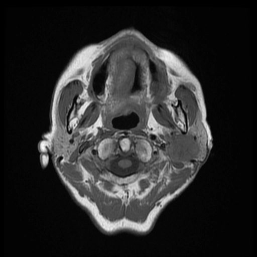 Ung thư biểu mô xuất phát từ u tuyến đa hình (Carcinoma ex pleomorphic adenoma - Ca-ex-PA)
