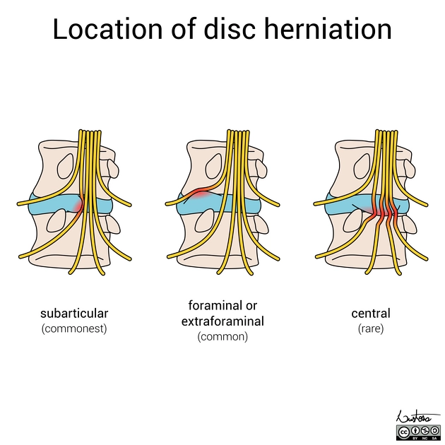 Cách đọc thoát vị đĩa đệm (Degenerated disc)