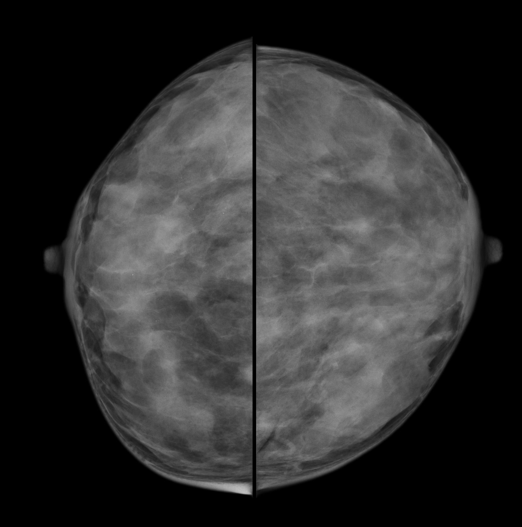 Mật độ mô vú (Breast density)