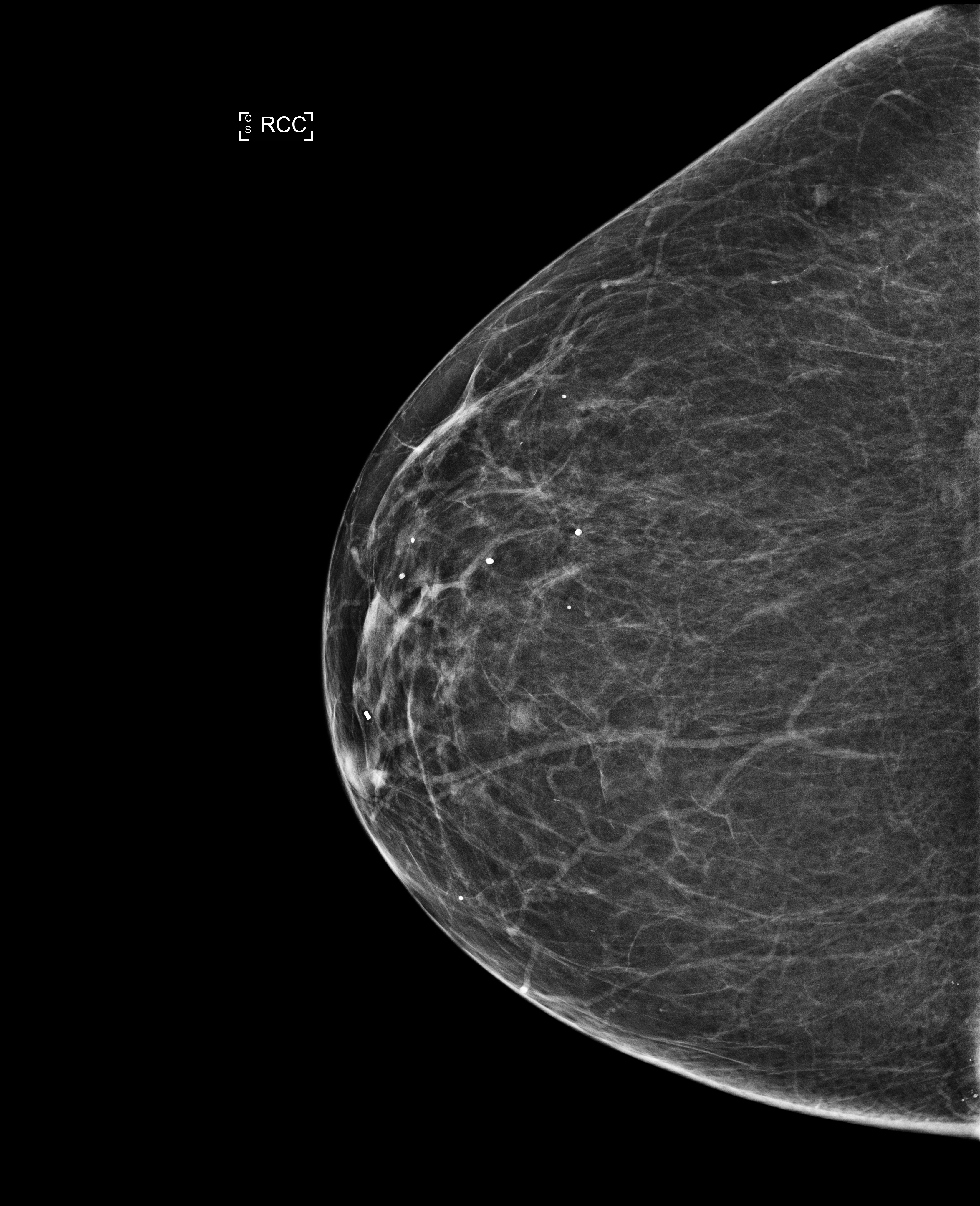 BI-RADS 1 (Breast imaging-reporting and data system (BI-RADS) assessment category 1)