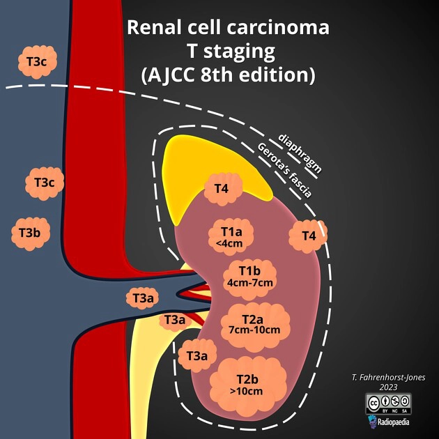 Phân loại giai đoạn Ung thư biểu mô tế bào thận (TNM)- Renal cell carcinoma (TNM staging)