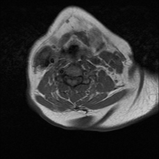 Thoái hóa đốt sống cổ (Cervical spondylosis)
