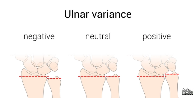 Lệch xương trụ (Ulnar variance)
