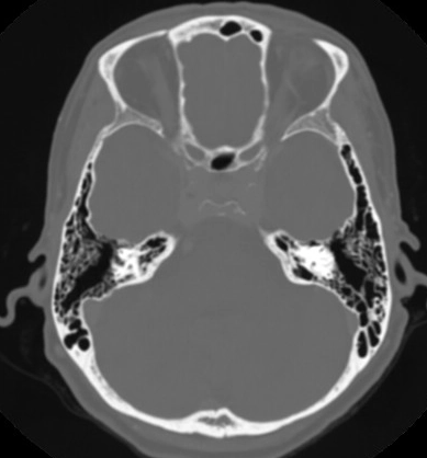 Động mạch cảnh trong lệch ra ngoài (Lateralized internal carotid artery)