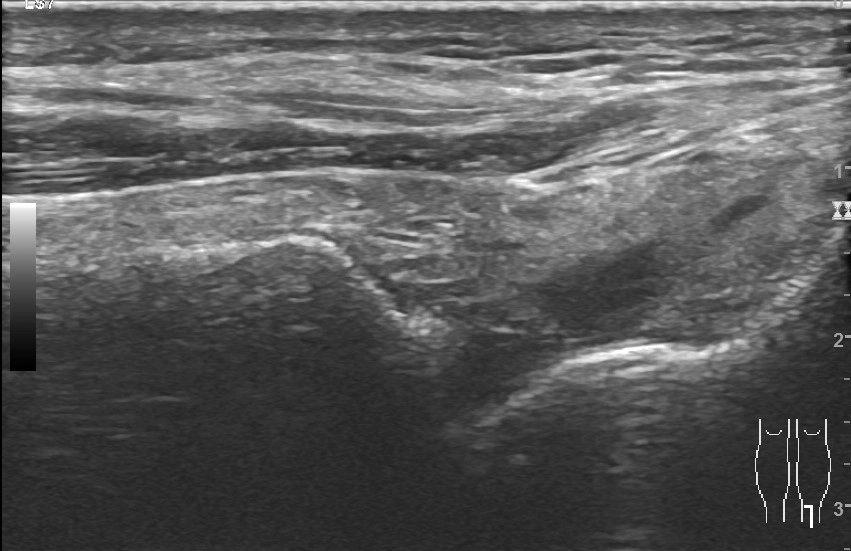 Gãy Tillaux-Chaput (gãy bong đầu dưới xương chày)