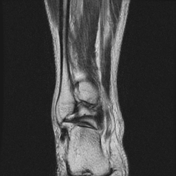 Viêm bao hoạt dịch sau gót (Retrocalcaneal bursitis) 