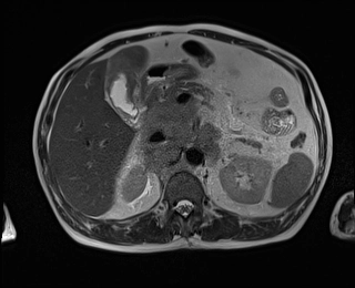 Lymphoma túi mật (Gallbladder lymphoma)