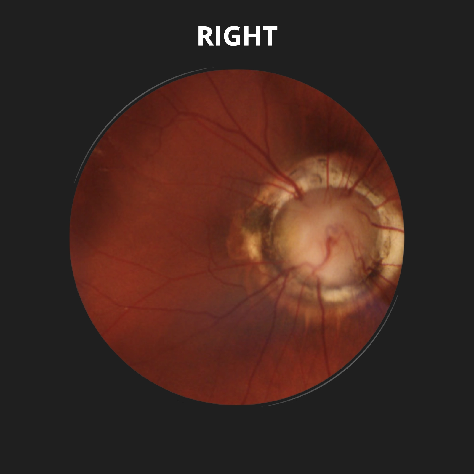 Tồn tại ống tuyến yên (Persistent hypophyseal canal)