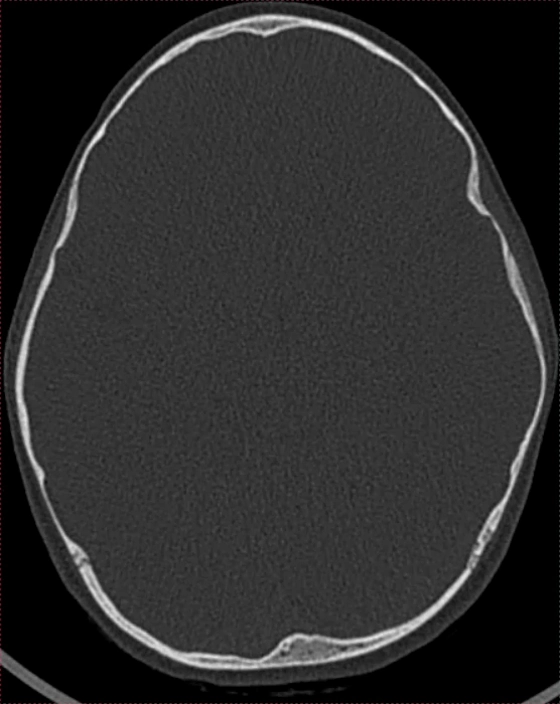 Phân chia không hoàn toàn ốc tai loại II (Cochlear incomplete partition type II)
