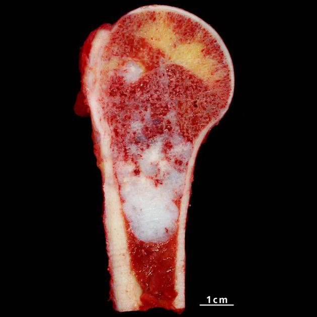  Sarcoma sụn (Chondrosarcoma)